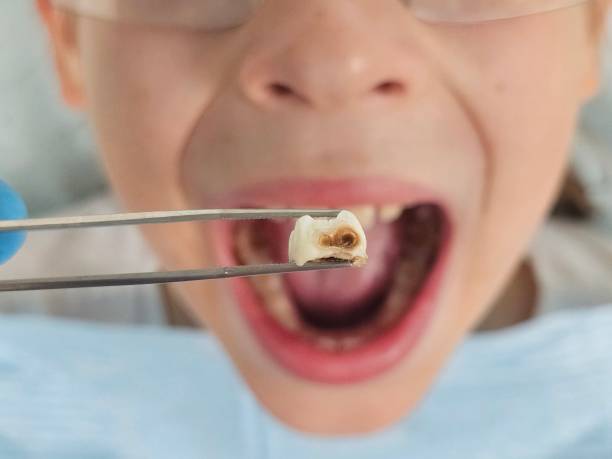 Best Emergency Root Canal Therapy in Dane, WI